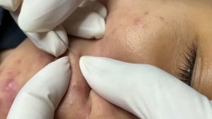 Удаление глубоких подкожных прыщей, черных точек и комедонов
