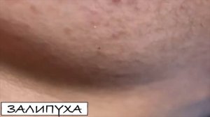ПРЫЩИ 😍 ПРЫЩИ ВЫДАВЛИВАНИЕ 😍 ПОДБОРКА ВЫДАВЛИВАНИЕ ПРЫЩЕЙ #прыщи #acne #asmr
