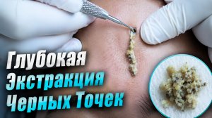 Мягкое удаление сальных нитей и интенсивная чистка забитых пор