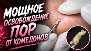 Глубокая чистка проблемной кожи с мощным удалением плотных пробок
