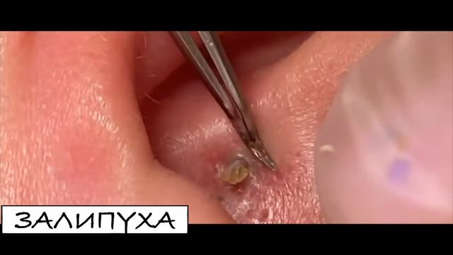 ПРЫЩИ ВЫДАВЛИВАНИЕ ВЫДАВЛИВАНИЕ ПРЫЩЕЙ ВЫДАВЛИВАНИЕ ЧЕРНЫХ ПРЫЩЕЙ #acne #прыщи #asmr смотреть онлайн