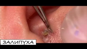 ПРЫЩИ ВЫДАВЛИВАНИЕ   ВЫДАВЛИВАНИЕ ПРЫЩЕЙ    ВЫДАВЛИВАНИЕ ЧЕРНЫХ ПРЫЩЕЙ #acne #прыщи #asmr