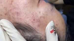 230 • Acne collection • АСМР • Relax Spa