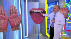 Вирус Коксаки: советы перед отпуском. Жить здорово! Фрагмент выпуска от 23.06.2026