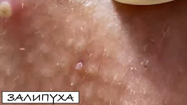 ВЫДАВЛИВАНИЕ ПРЫЩЕЙ 😍 ПРЫЩИ НА ЛИЦЕ 😍 #asmr #acne #прыщи смотреть онлайн