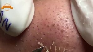 Удаление прыщей с носа и щек Spa  #077