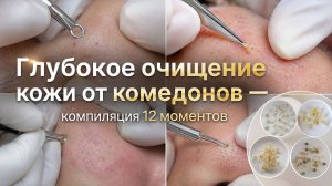 Мягкая экстракция сальных пробок и нежное удаление акне с кистами