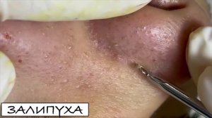 ПРЫЩИ 😍 ПРЫЩИ ВЫДАВЛИВАНИЕ 😍 ПОДБОРКА ВЫДАВЛИВАНИЕ ПРЫЩЕЙ #прыщи #acne #asmr #какубратьпрыщи