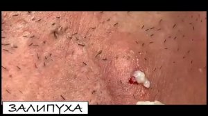 ПРЫЩИ ВЫДАВЛИВАНИЕ. ВЫДАВЛИВАНИЕ ПРЫЩЕЙ. САМОЕ ЗАЛИПАТЕЛЬНОЕ ВИДЕО #прыщи #прыщивыдавливание #acne