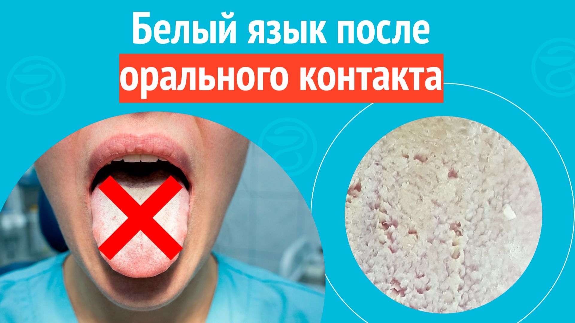 👅 Белый язык после орального контакта. Клинический случай № 1714 смотреть онлайн