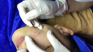 Комплексная чистка лица от прыщей и акне
