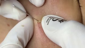 Удаление прыщей, черных точек и комедонов с лица