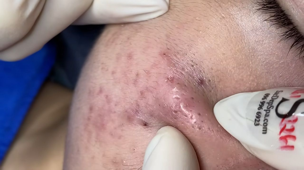 236 • Acne collection • АСМР • Relax Spa смотреть онлайн