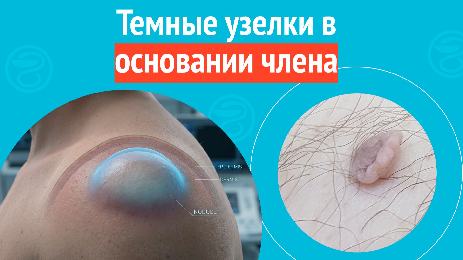 👉 Темные узелки в основании члена. Клинический случай № 1712 смотреть онлайн