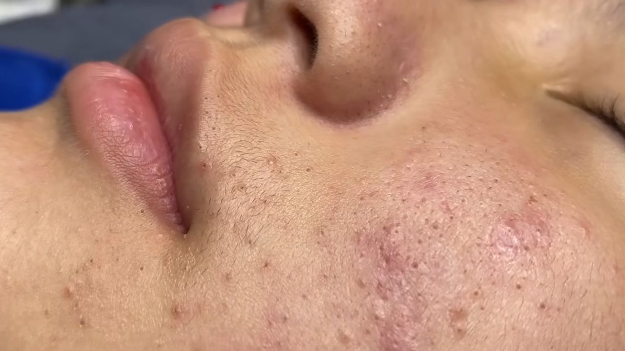 237 • Acne collection • АСМР • Relax Spa смотреть онлайн
