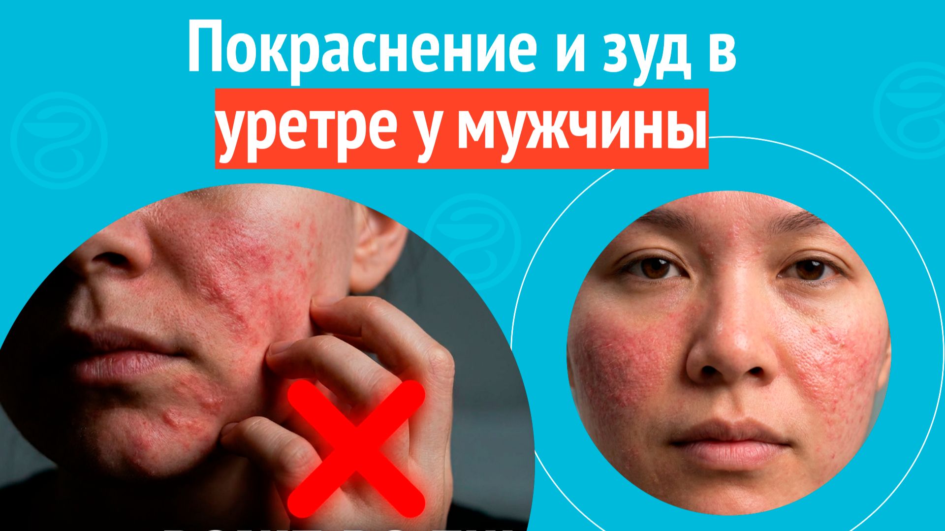 😡 Покраснение и зуд в уретре у мужчины. Клинический случай №1709 смотреть онлайн