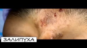 ВЫДАВЛИВАНИЕ ПРЫЩЕЙ. ВЫДАВЛИВАНИЕ ЧЕРНЫХ ТОЧЕК. УДАЛЕНИЕ И ВЫДАВЛИВАНИЕ ЧЕРНЫХ ТОЧЕК.УДАЛЕНИЕ ПРЫЩЕ
