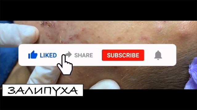 ВЫДАВЛИВАНИЕ КРАСНЫХ ПРЫЩЕИ. ЛЕЧЕНИЕ АКНЕ НА ЛИЦЕ. ВЫДАВЛИВАНИЕ ЧЕРНЫХ ТОЧЕК НА ЛИЦЕ. ЧИСТКА ЛИЦА 😍 смотреть онлайн