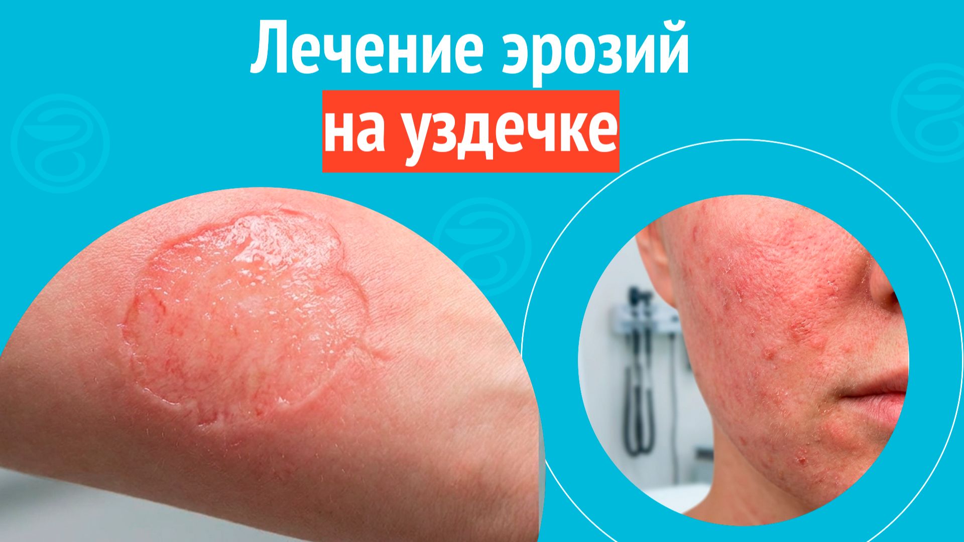 🥺 Лечение эрозий на уздечке. Клинический случай № 1713 смотреть онлайн