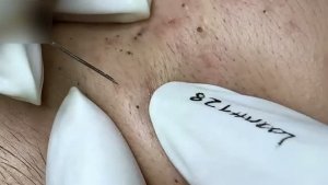 #280 Удаление акне. Экстракция комедонов. Подкожные прыщи. Чистка от черных точек