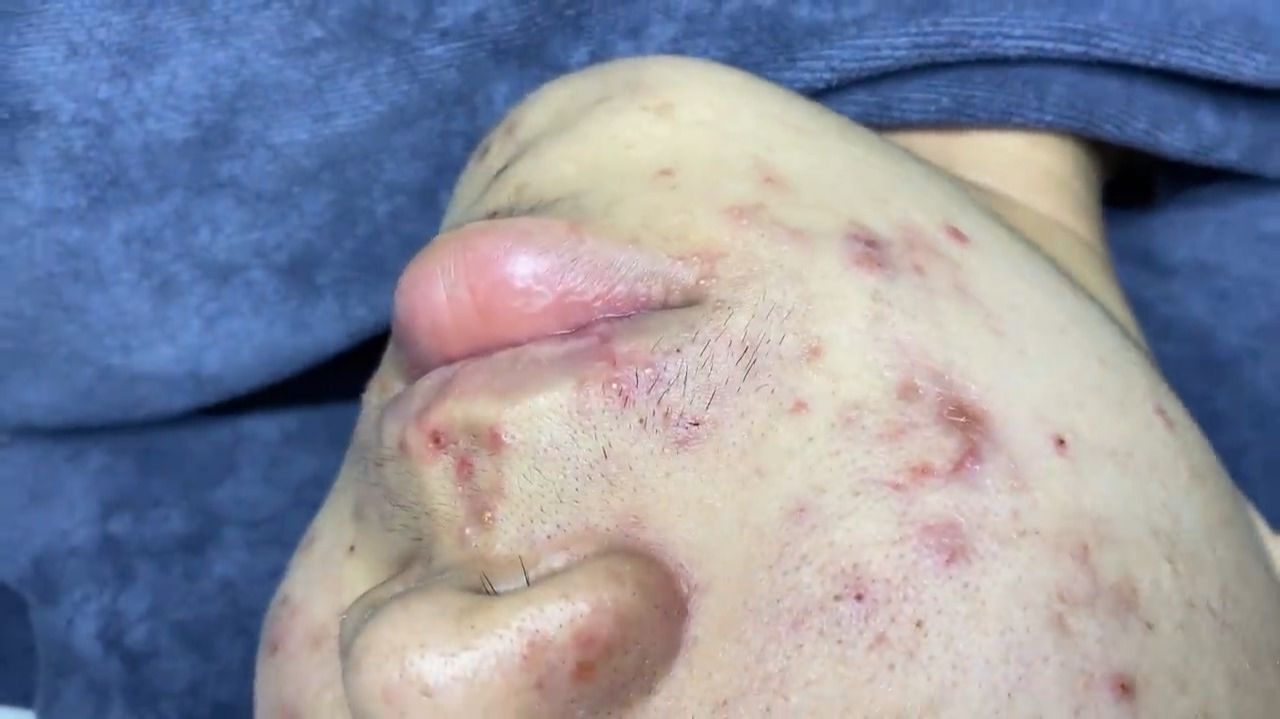 227 • Acne collection • АСМР • Relax Spa смотреть онлайн