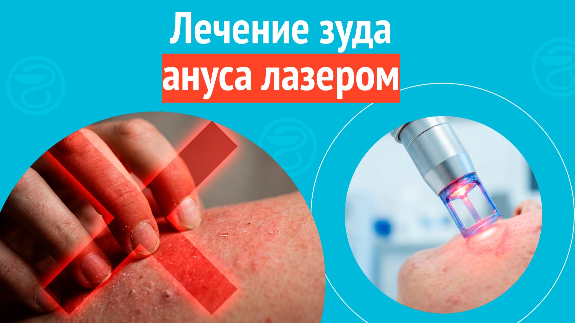 ✅ Лечение зуда ануса лазером. Клинический случай № 1717 смотреть онлайн