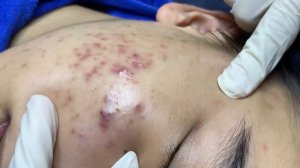 222 • Acne collection • АСМР • Relax Spa