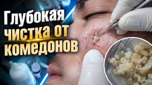 Мягкая чистка акне с экстракцией закрытых комедонов и очищением проблемной кожи