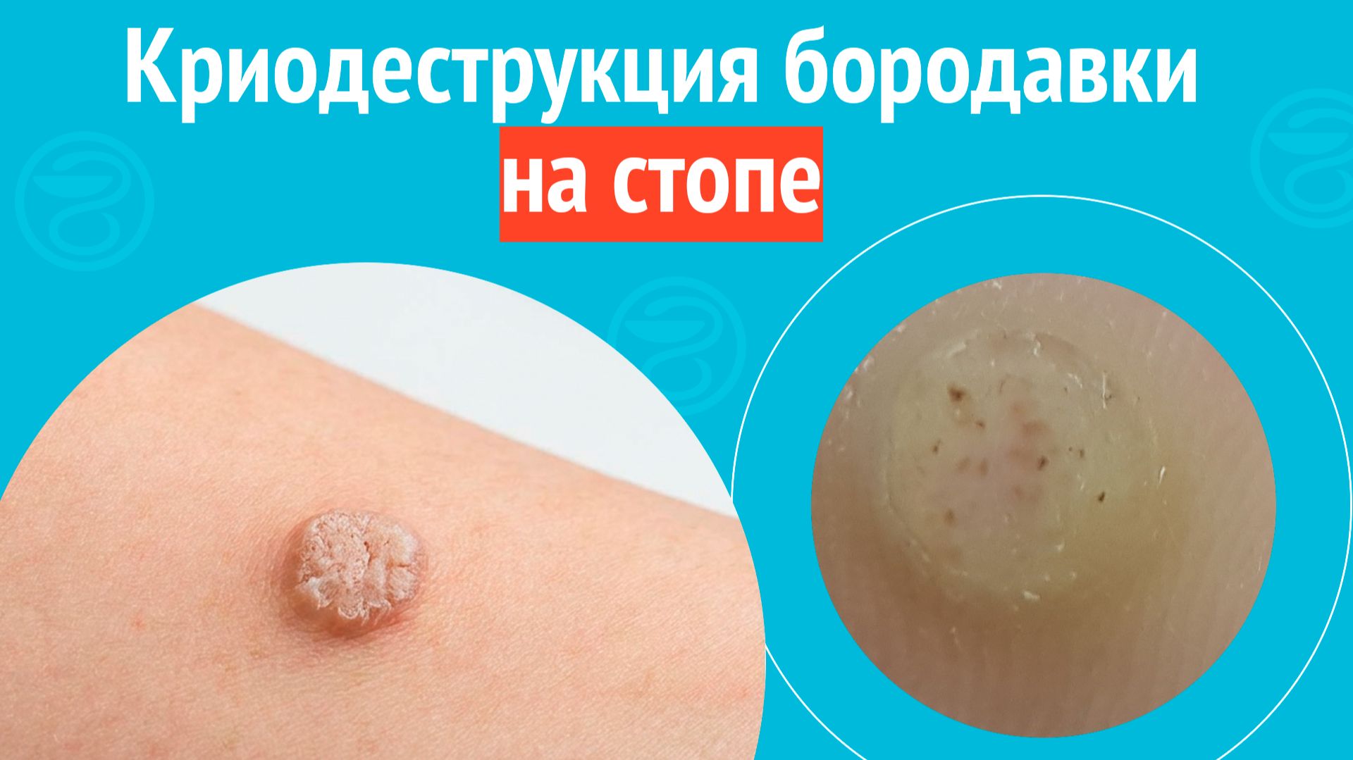 🦶 Криодеструкция бородавки на стопе. Клинический случай № 1715 смотреть онлайн