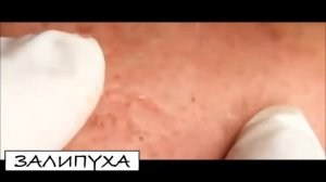 ВЫДАВЛИВАНИЕ ПРЫЩЕЙ  ОГРОМНЫЕ БЕЛЫЕ ПРЫЩИ  ЧЕРНЫЕ ТОЧКИ АКНЕ  КАК УБРАТЬ ЧЕРНЫЕ ТОЧКИ  ПРЫЩИ НА ЛИЦ