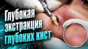 Интенсивное удаление внутренних комедонов и сальных нитей для чистки проблемной кожи