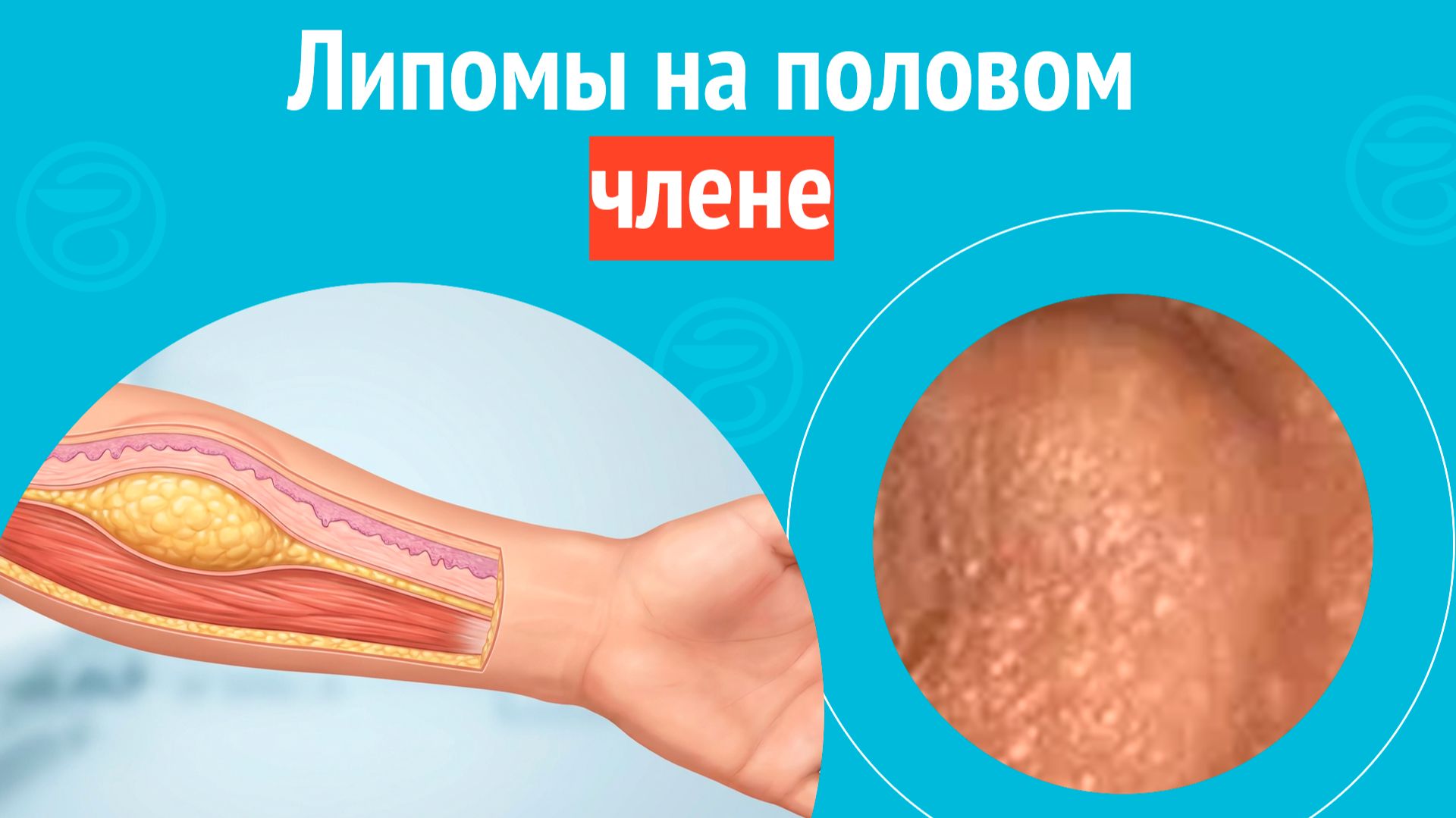 👉 Липомы на половом члене. Клинический случай № 1716 смотреть онлайн