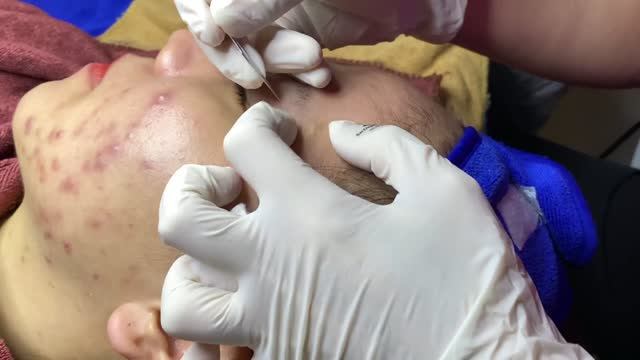 Удаление черных точек и комедонов с лица — пошаговый процесс смотреть онлайн