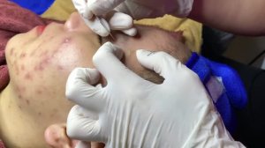 Удаление черных точек и комедонов с лица — пошаговый процесс