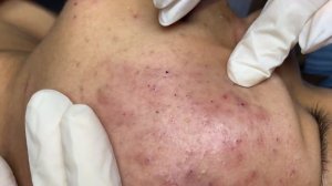225 • Acne collection • АСМР • Relax Spa