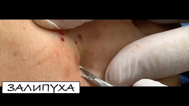ВЫДАВЛИВАЕТ ПРЫЩИ И УГРИ. СОЧНОЕ РЕЛАКС ВИДЕО давить угри и прыщи видео давят прыщи и смотреть онлайн