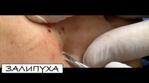 ВЫДАВЛИВАЕТ ПРЫЩИ И УГРИ. СОЧНОЕ РЕЛАКС ВИДЕО давить угри и прыщи видео давят прыщи и