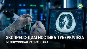 Экспресс-диагностику туберкулеза разработали в Беларуси: удастся ли победить болезнь к 2030 году?
