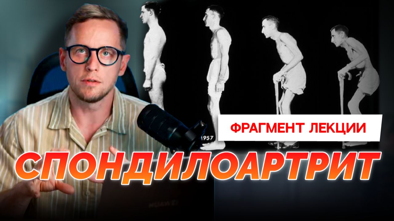 Спондилоартрит согнет и уничтожит, если не лечить. Как работать с этим заболеванием