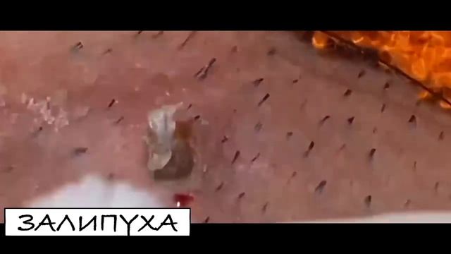 ПРЫЩИ ВЫДАВЛИВАНИЕ. ВЫДАВЛИВАНИЕ ОДНОГО БЕЛОГО ПРЫЩА. БЕЛЫЙ ЖИРНЫЙ ПРЫЩ. ПРЫЩИ ВЫДАВЛИВАНИЕ НОВОЕ смотреть онлайн