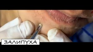 ПРЫЩИ ВЫДАВЛИВАНИЕ. ВЫДАВЛИВАНИЕ ПРЫЩЕЙ. ВЫДАВЛИВАНИЕ ЧЕРНЫХ ТОЧЕК НА ЛИЦЕ. ПРЫЩИ ВЫДАВЛИВАНИЕ.