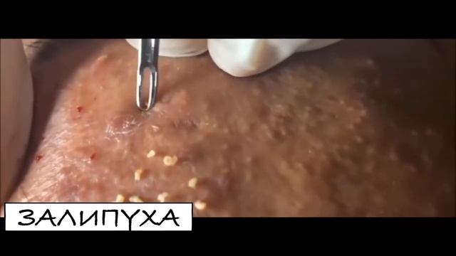 ВЫДАВЛИВАЕТ ПРЫЩИ И УГРИ. СОЧНОЕ РЕЛАКС ВИДЕО давить угри и прыщи смотреть онлайн
