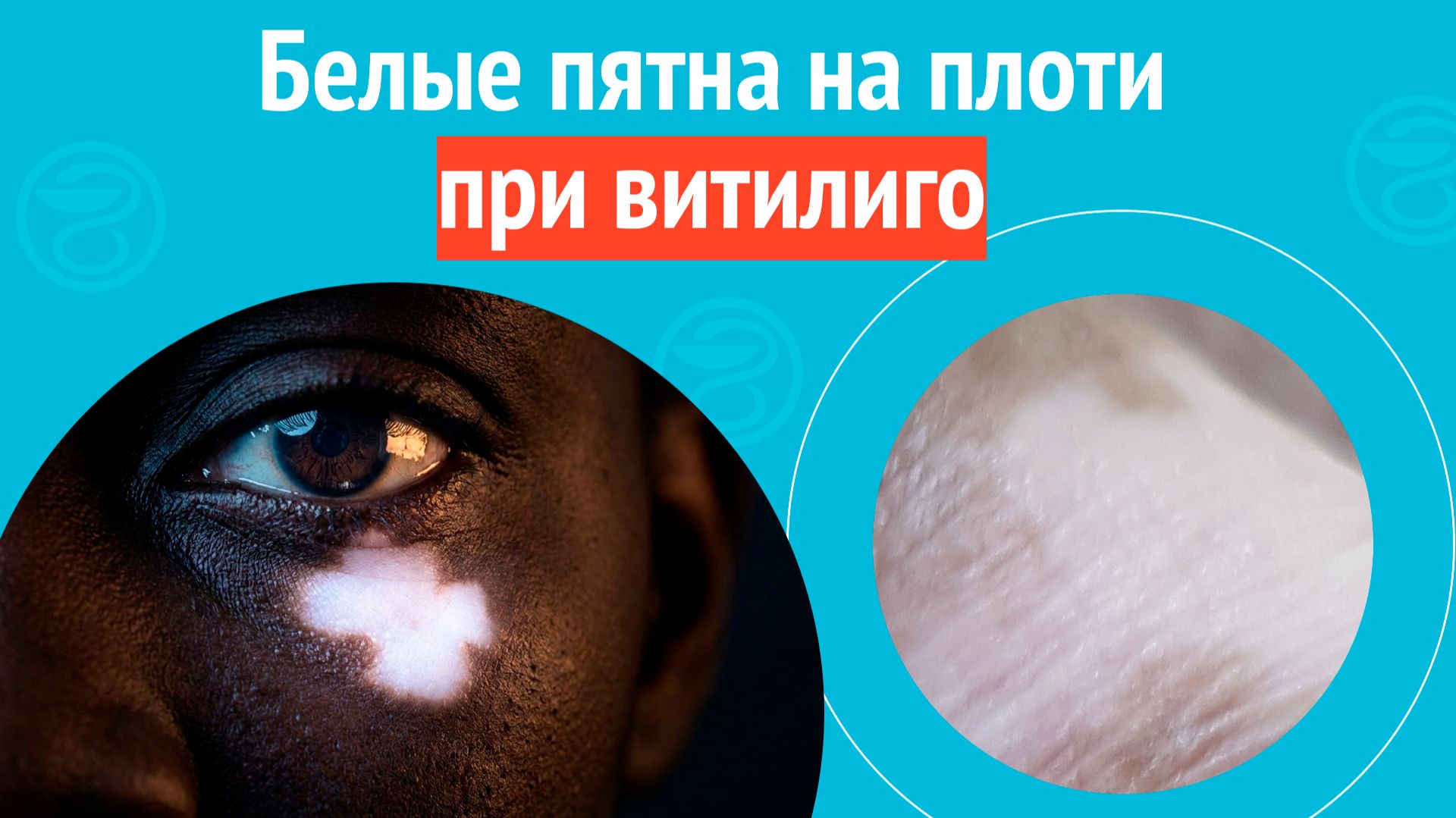 🙁 Белые пятна на плоти при витилиго. Клинический случай № 1710 смотреть онлайн