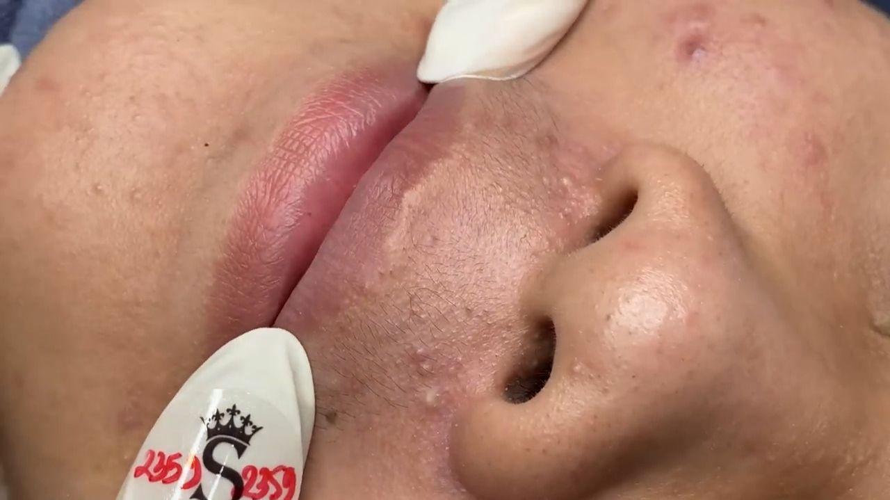 233 • Acne collection • АСМР • Relax Spa смотреть онлайн