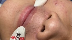 233 • Acne collection • АСМР • Relax Spa