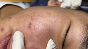 240 • Acne collection • АСМР • Relax Spa