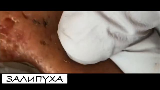 ПРЫЩИ - ВЫДАВЛИВАНИЕ. ЧИСТКА ЛИЦА ОТ УГРЕЙ. УДАЛЕНИЕ ЧЕРНЫХ ТОЧЕК НА ТЕЛЕ. АКНЕ 😍😍😍 смотреть онлайн