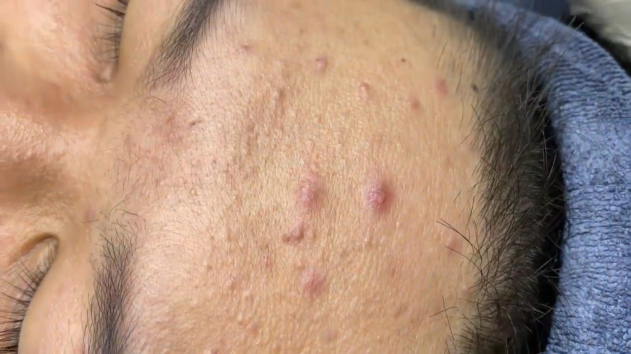 232 • Acne collection • АСМР • Relax Spa смотреть онлайн