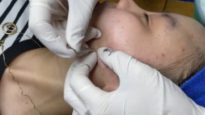 Чистка лица от прыщей, черных точек и белых угрей