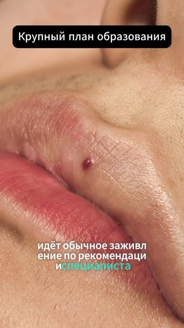 Удаление сосудистого образования на губе у мужчины
